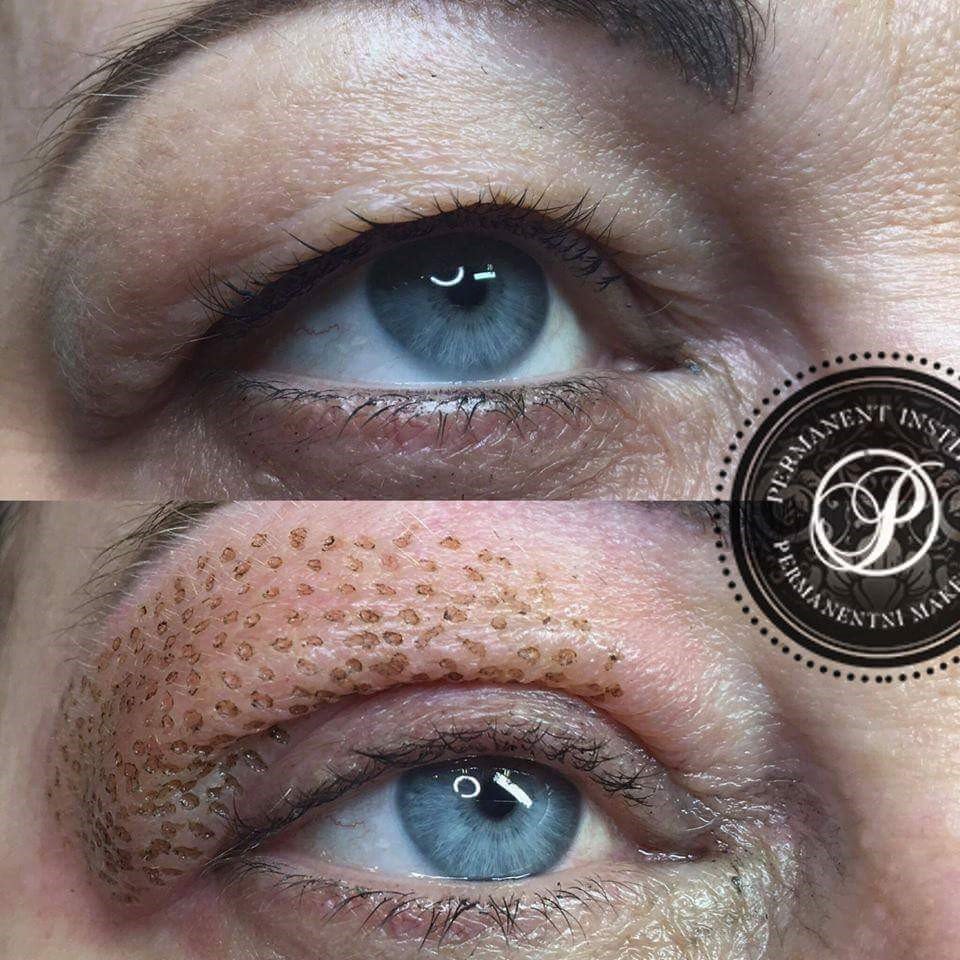 Purebeau Fibroblast Nonsurgical facelift in Leeds